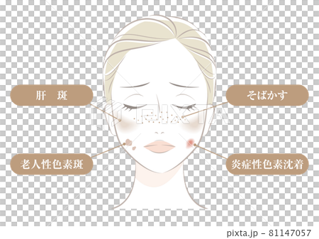 シミの種類 81147057