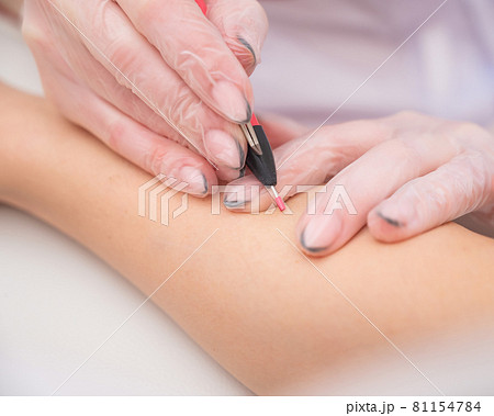The doctor makes electro epilation of the woman's hands in the salon. Close-up of hardware removal of unwanted hair forever 81154784
