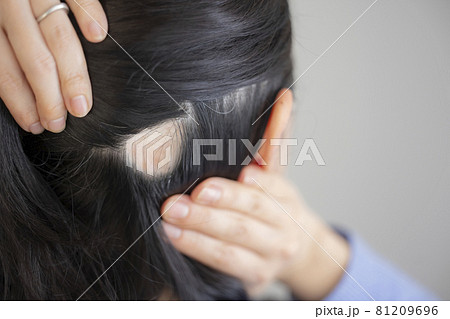 円形脱毛　女性　 81209696