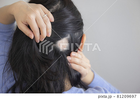 円形脱毛　女性　 81209697