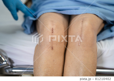 Asian senior or elderly old lady woman patient show her scars surgical total knee joint replacement Suture wound surgery arthroplasty on bed in nursing hospital ward, healthy strong medical concept. Asian senior or elderly old lady woman patient show her scars surgical total knee joint replacement Suture wound surgery arthroplasty on bed in nursing hospital ward, healthy strong medical concept. 81210402