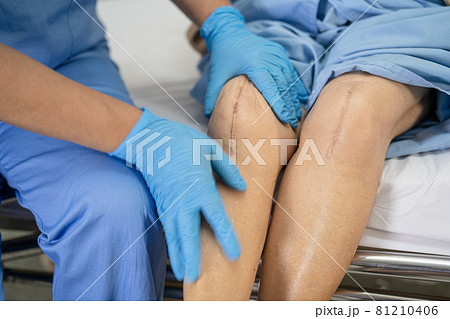 Asian senior or elderly old lady woman patient show her scars surgical total knee joint replacement Suture wound surgery arthroplasty on bed in nursing hospital ward, healthy strong medical concept. Asian senior or elderly old lady woman patient show her scars surgical total knee joint replacement Suture wound surgery arthroplasty on bed in nursing hospital ward, healthy strong medical concept. 81210406