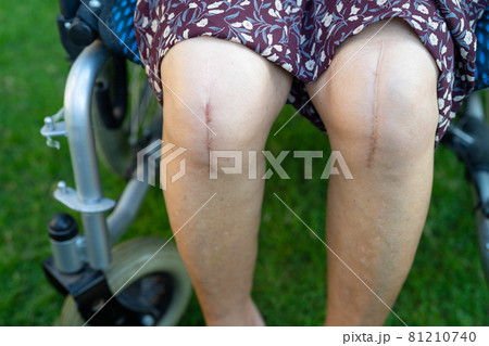 Asian senior or elderly old lady woman patient show her scars surgical total knee joint replacement Suture wound surgery arthroplasty on bed in nursing hospital ward, healthy strong medical concept. Asian senior or elderly old lady woman patient show her scars surgical total knee joint replacement Suture wound surgery arthroplasty on bed in nursing hospital ward, healthy strong medical concept. 81210740