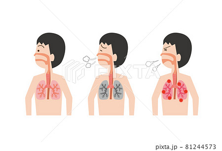 肺の状態のセットイラスト 肺の状態のセットイラスト 81244573