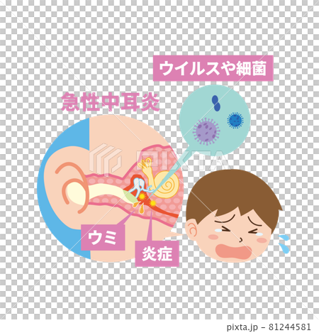 急性中耳炎で泣く男児 81244581