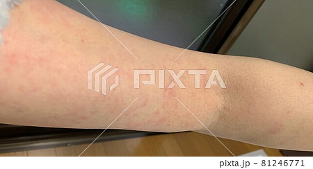 湿疹・薬疹 81246771