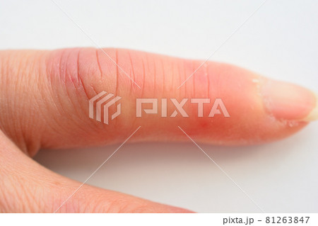 しもやけで腫れた左手の小指 81263847