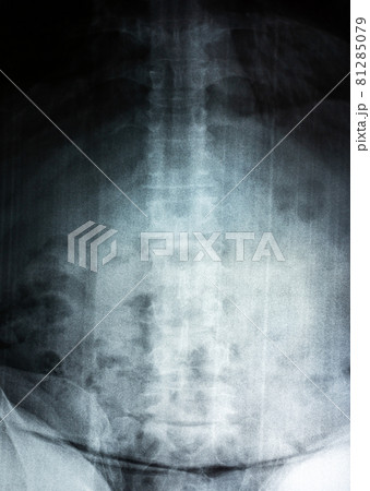 Film X-ray of spine 81285079