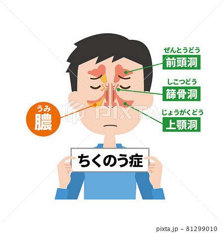 蓄膿症男性の鼻の内部イメージ 81299010