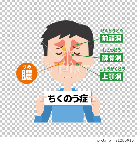 蓄膿症男性の鼻の内部イメージ 81299010