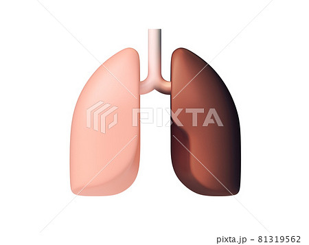 3d illustration of healthy and unhealthy human lungs 81319562