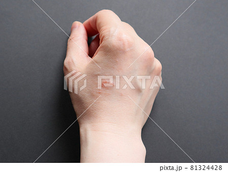 皮膚炎 肌トラブル 肌荒れ 湿疹 手湿疹 主婦湿疹 家事湿疹 26 皮膚炎 肌トラブル 肌荒れ 湿疹 手湿疹 主婦湿疹 家事湿疹 26 81324428