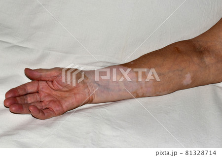 Woman's right hand damaged by vitiligo disease, palm up. 81328714