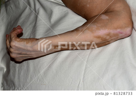 An arm bent at the elbow with vitiligo disease. An arm bent at the elbow with vitiligo disease. 81328733