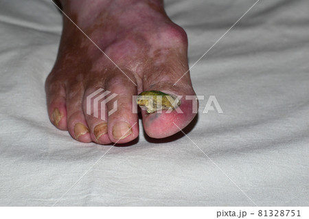 Close-up of the right foot with a keratinous fungal growth on the toenail. 81328751