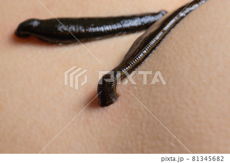 Traditional alternative medicine - doctor doing procedure of hirudotherapy for young woman. 81345682