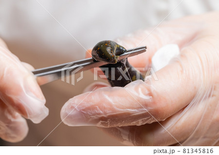 Traditional alternative medicine - doctor doing procedure of hirudotherapy for young woman. Traditional alternative medicine - doctor doing procedure of hirudotherapy for young woman. 81345816