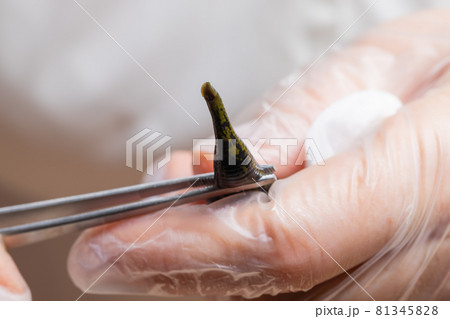 Traditional alternative medicine - doctor doing procedure of hirudotherapy for young woman. 81345828