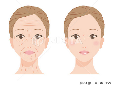 女性の顔のしわ 女性の顔のしわ 81361459