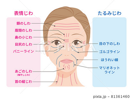 しわの種類 81361460
