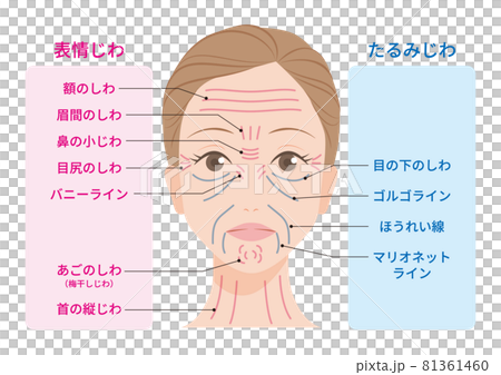 しわの種類 81361460