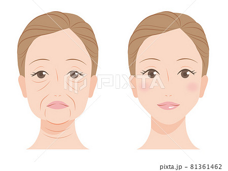 顔のたるみ 81361462