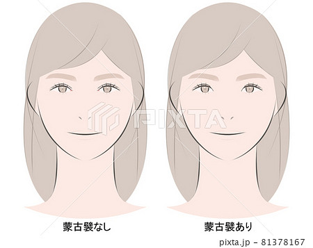 蒙古襞ありなし比較 81378167