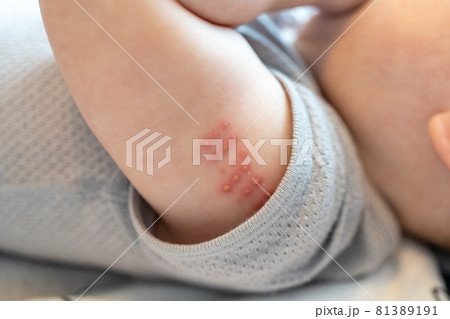 BCG注射をした赤ちゃんの腕 81389191