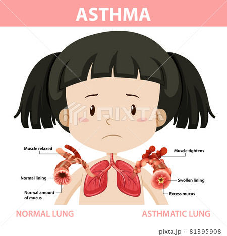 Asthma diagram with normal lung and asthmatic lungのイラスト素材 [81395908 ...