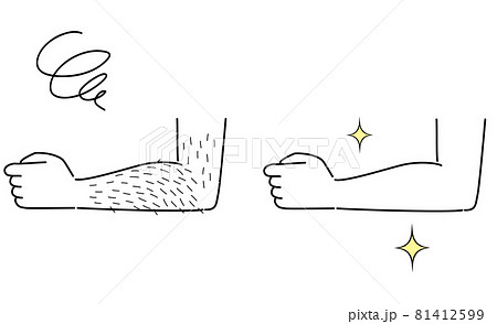 毛深い腕と、脱毛したきれいな腕　ビフォーアフター 81412599