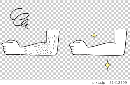 毛深い腕と、脱毛したきれいな腕　ビフォーアフター 81412599