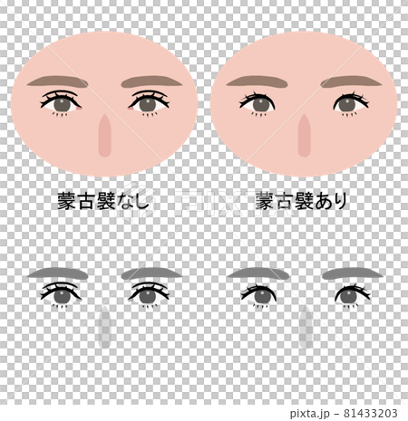 有無蒙古褶的比較 2 可笑的眼睛 有無蒙古褶的比較 2 可笑的眼睛 81433203