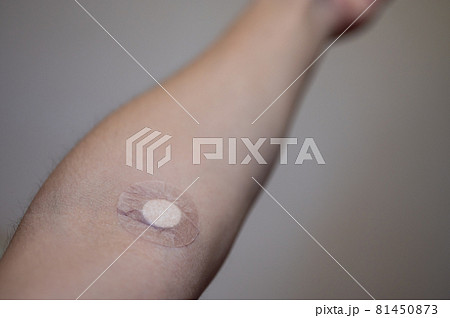 採血後の腕と絆創膏 採血後の腕と絆創膏 81450873