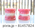 歯科矯正模型 81457824