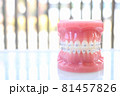 歯科矯正模型 81457826