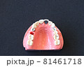 補綴説明模型 81461718