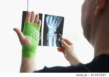 A man looks at an x-ray and a hand in a bandage A man looks at an x-ray and a hand in a bandage 81467697