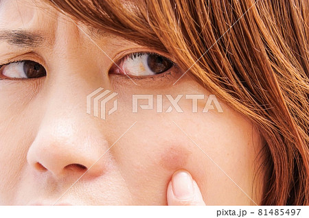 ほおを気にする女性 81485497