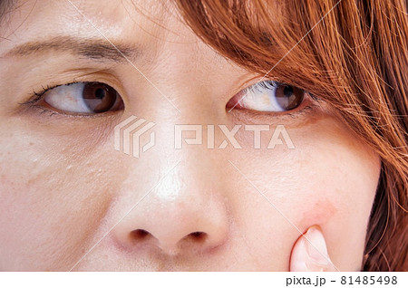 ほおを気にする女性 ほおを気にする女性 81485498