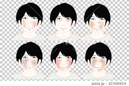 6 illustrations of atopic dermatitis facial cases 6 illustrations of atopic dermatitis facial cases 81500954