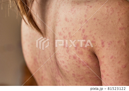 allergic rash on the body of the patient. 5 year old girl.  81523122