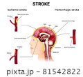 causes of stroke and the development of the disease 81542822