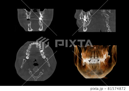 Set of MRI scanner slices of dental part of human male scull with multiple problems on white background. 81574872