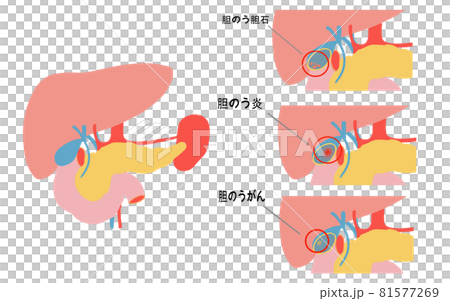 内臓　胆のうの病気イラスト 81577269