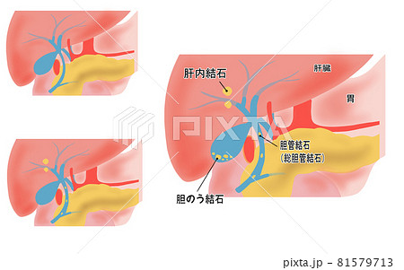 胆のう結石の図説イラスト 81579713