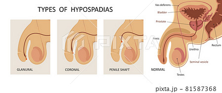 Types of hypospadias. Sideview opening of urethra. 81587368