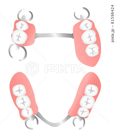 部分入れ歯（咬合面） 81596424