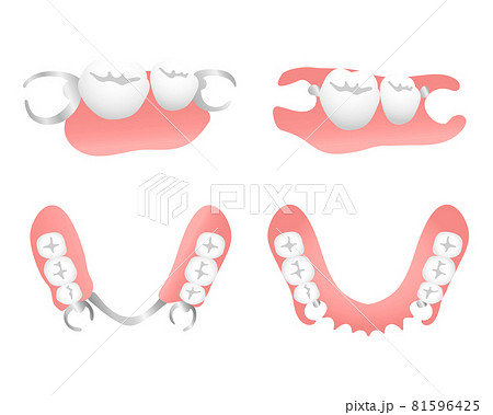 ノンクラスプデンチャーと保険の入れ歯のイラスト素材 [81596425] - PIXTA