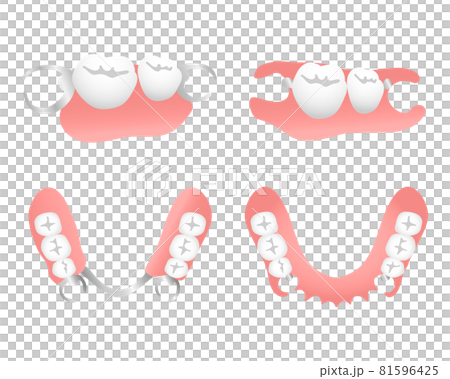 ノンクラスプデンチャーと保険の入れ歯 ノンクラスプデンチャーと保険の入れ歯 81596425