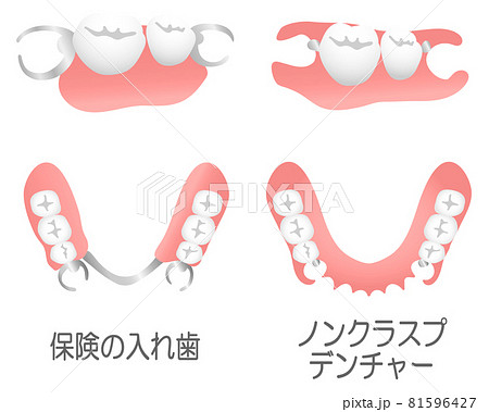 ノンクラスプデンチャー 保険入れ歯 比較模型 ショップ